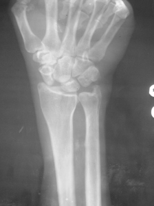 Note the increased gap between scaphoid and lunate